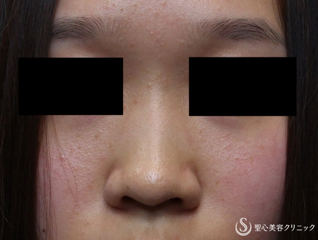 【20代女性・鼻を自然に高く】プロテーゼ+耳介軟骨（1ヶ月後） Before 