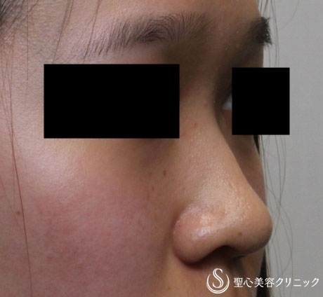 【20代女性・鼻を自然に高く】プロテーゼ+耳介軟骨（1ヶ月後） Before 