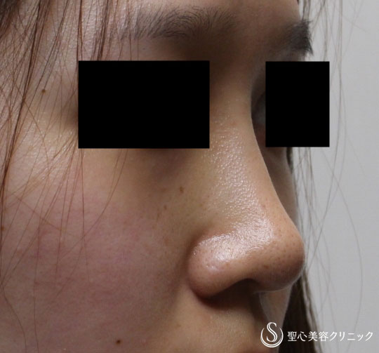 【20代女性・鼻を自然に高く】プロテーゼ+耳介軟骨（1ヶ月後） After 