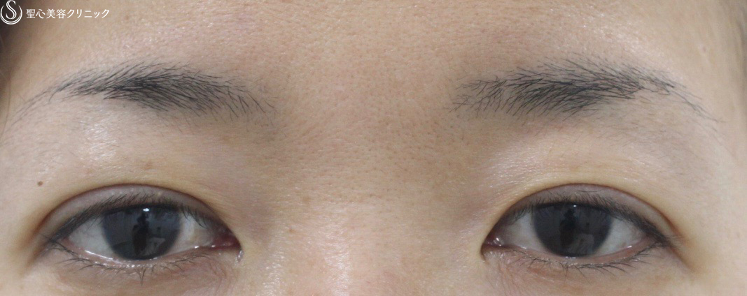 【30代女性・自然な二重に】埋没法マイクロメソッド+α（２点留め）（1ヶ月後） After 