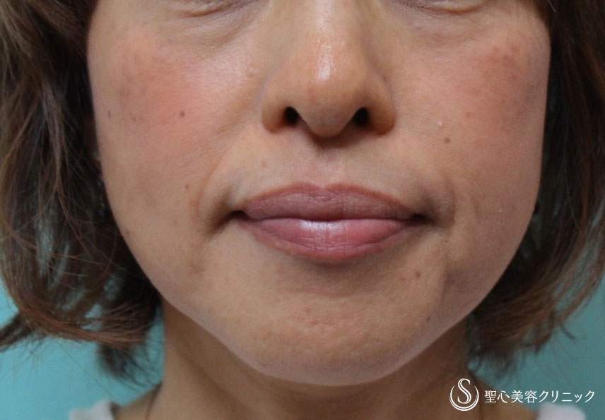 【50代女性・目の下のたるみとほうれい線を改善】プレミアムPRP皮膚再生療法（1年後） Before 