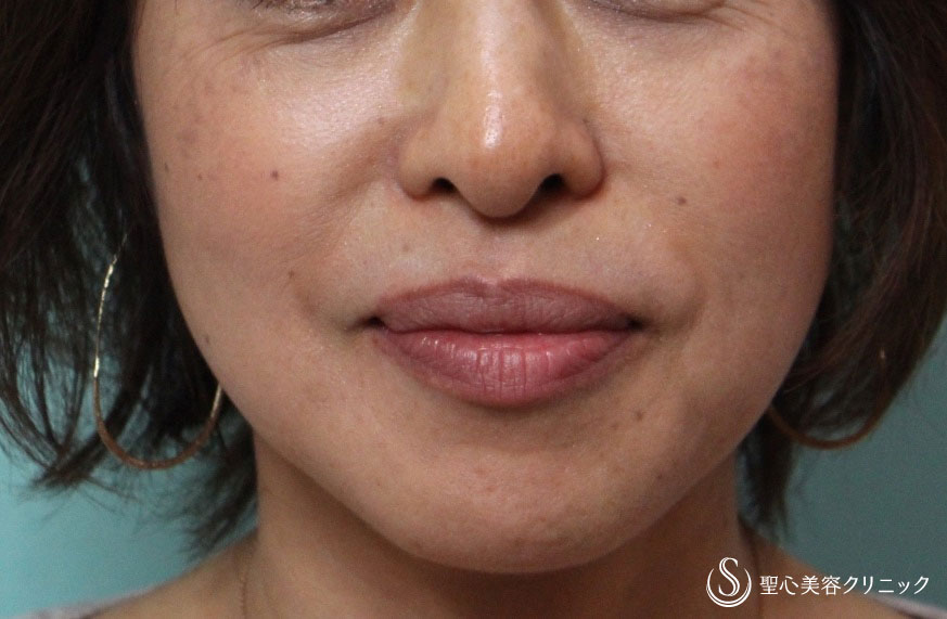 【50代女性・目の下のたるみとほうれい線を改善】プレミアムPRP皮膚再生療法（1年後） After 