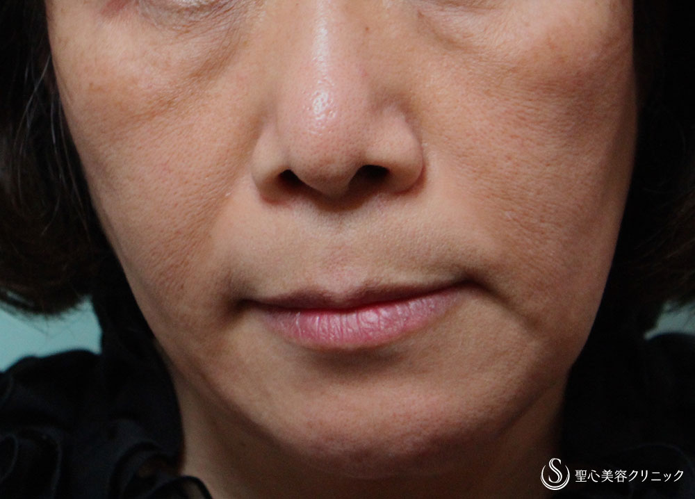 【50代女性・インディアンラインの改善】プレミアムPRP皮膚再生療法（1年後） Before 