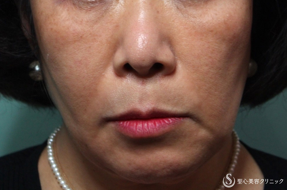 【50代女性・インディアンラインの改善】プレミアムPRP皮膚再生療法（1年後） After 