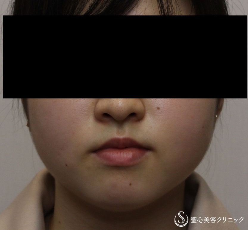 【女性・切らずに脂肪溶解注射だけですっきりと】FatX2回（1ヶ月後） Before 