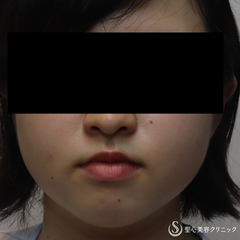 【女性・切らずに脂肪溶解注射だけですっきりと】FatX2回（1ヶ月後） After 