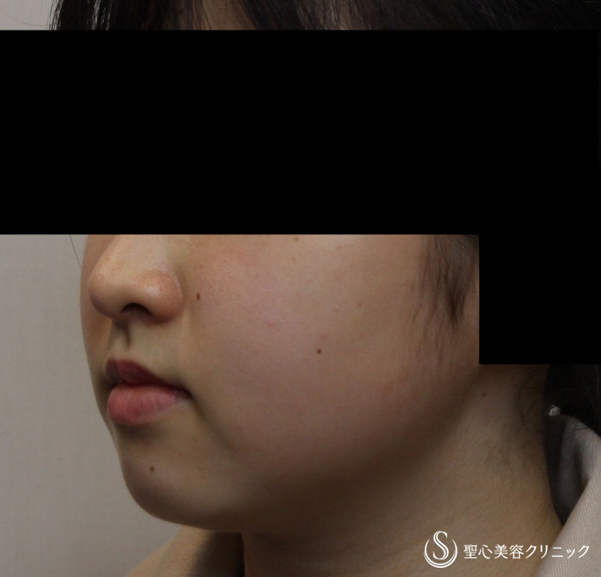 【女性・切らずに脂肪溶解注射だけですっきりと】FatX2回（1ヶ月後） Before 