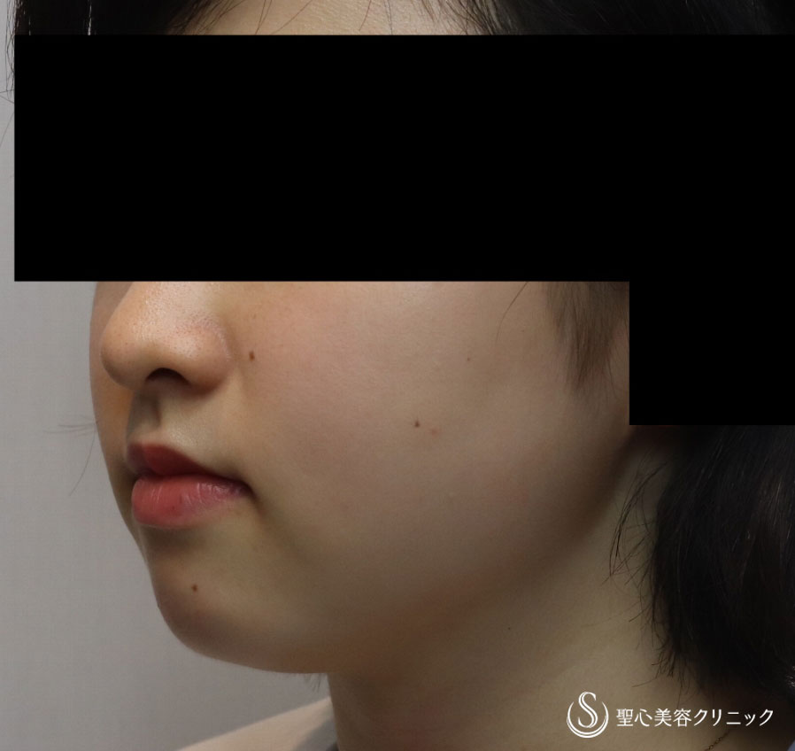 【女性・切らずに脂肪溶解注射だけですっきりと】FatX2回（1ヶ月後） After 