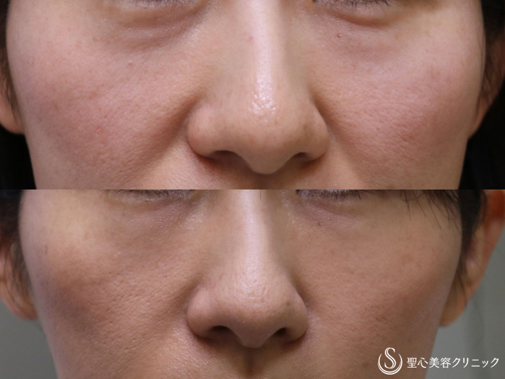 【40代女性・目の下のクマとたるみを改善】プレミアムPRP 皮膚再生療法（2回後） After 