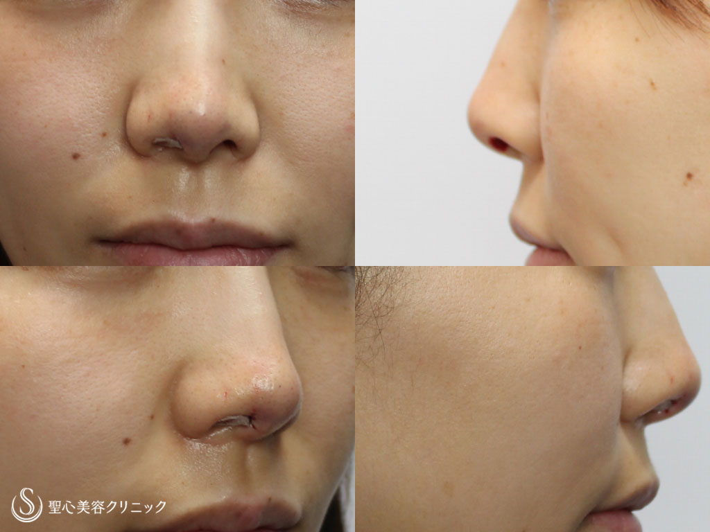 【20代女性・鼻先の形を綺麗に】耳介軟骨移植（1週間後） Before 