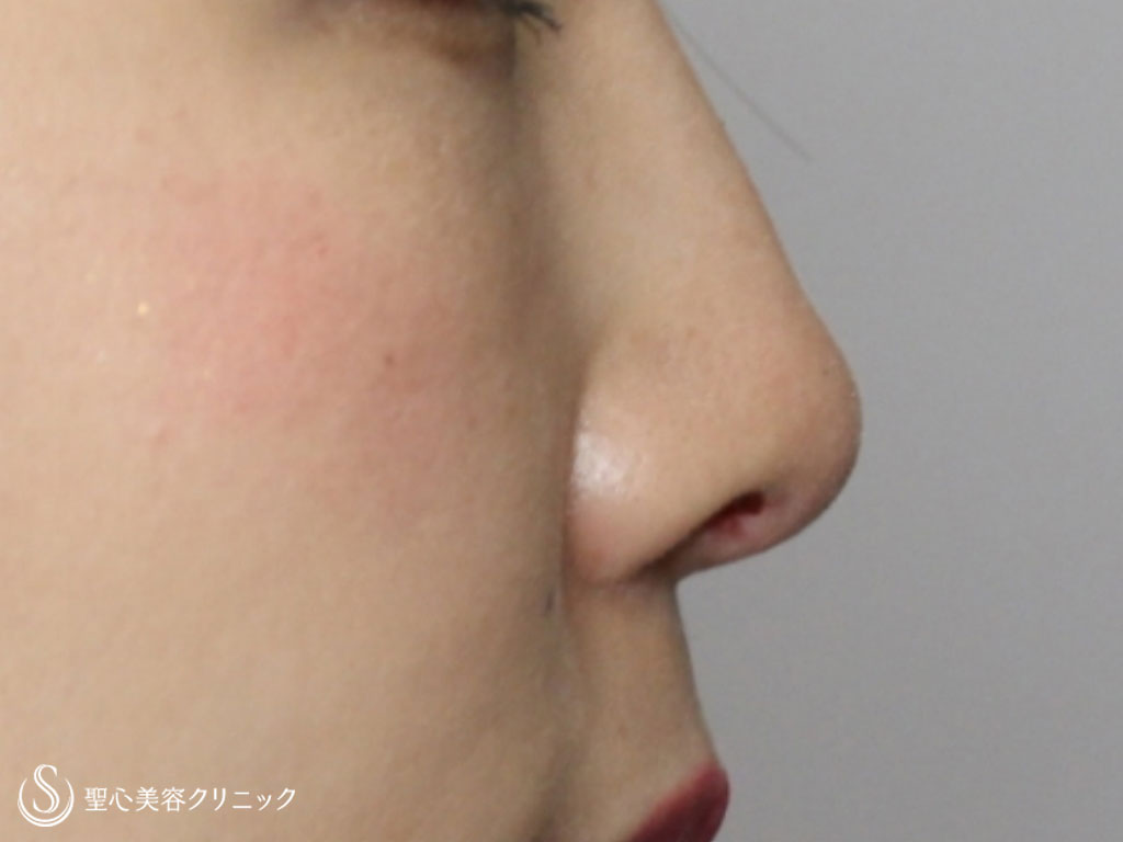 【20代女性・鼻先の形を綺麗に】耳介軟骨移植（1週間後） After 