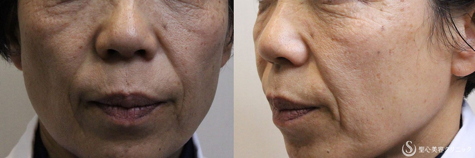 【60代女性・ほうれい線の改善】プレミアムPRP皮膚再生療法（2年半後） Before 