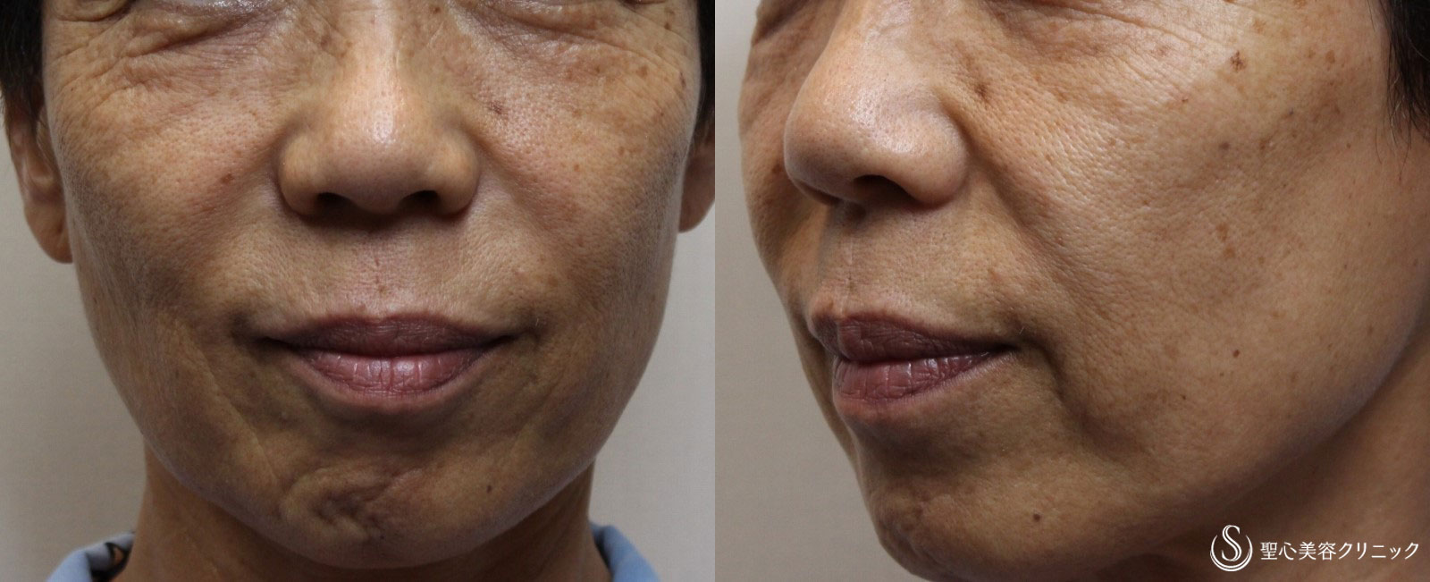 【60代女性・ほうれい線の改善】プレミアムPRP皮膚再生療法（2年半後） After 