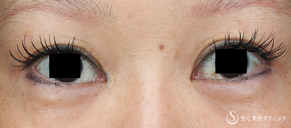 40代女性 たれ目形成で優しそうな目元に グラマラスライン外側切開法 1ヶ月後 症例写真 美容整形 美容外科なら聖心美容クリニック