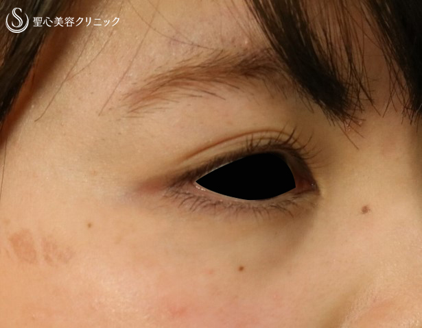 【20代女性・目の下のくまを改善】プレミアムPRP皮膚再生療法（半年後） Before 