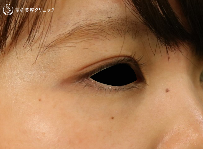 【20代女性・目の下のくまを改善】プレミアムPRP皮膚再生療法（半年後） After 