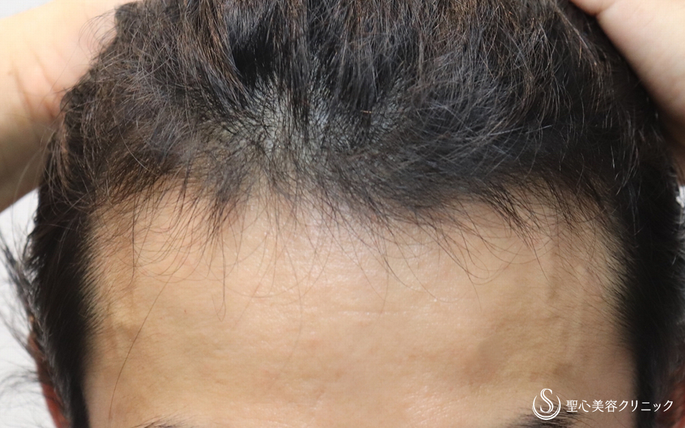 【30代男性・M字がなくなり髪の毛増加（内服治療）】ザガーロ＋ミノキシジルタブレット（3ヶ月後） After 