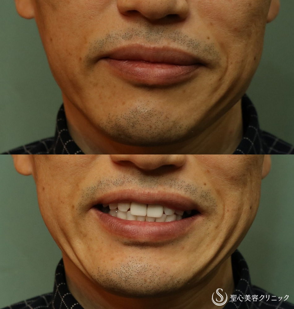 【50代男性・ほうれい線、口横のしわを改善】プレミアムPRP皮膚再生療法（3ヶ月後） Before 