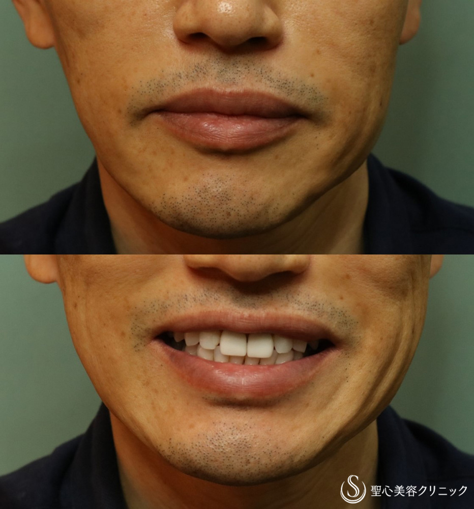 【50代男性・ほうれい線、口横のしわを改善】プレミアムPRP皮膚再生療法（3ヶ月後） After 