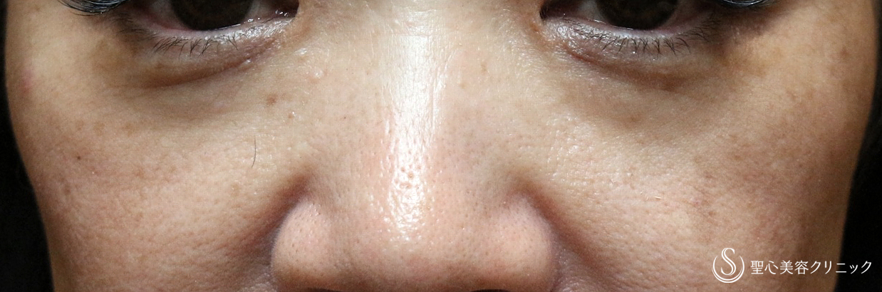 【50代女性・目の下のクマ】プレミアムPRP皮膚再生療法（2年後）札幌院 Before 