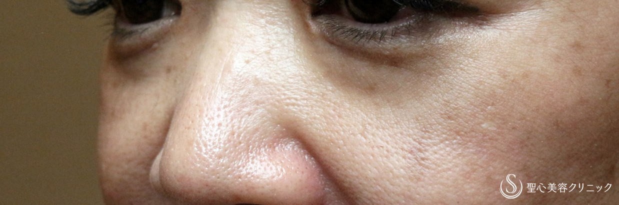 【50代女性・目の下のクマ】プレミアムPRP皮膚再生療法（2年後）札幌院 Before 