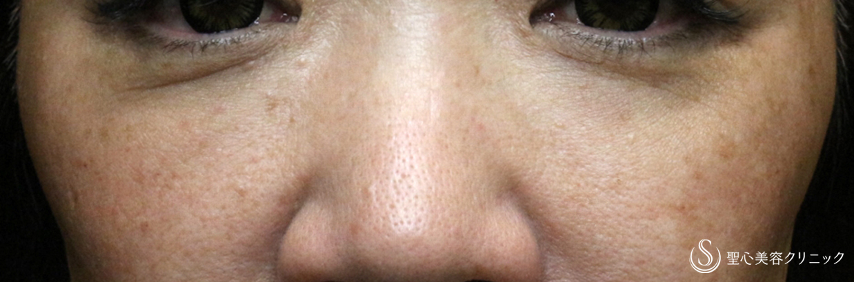 【50代女性・目の下のクマ】プレミアムPRP皮膚再生療法（2年後）札幌院 After 