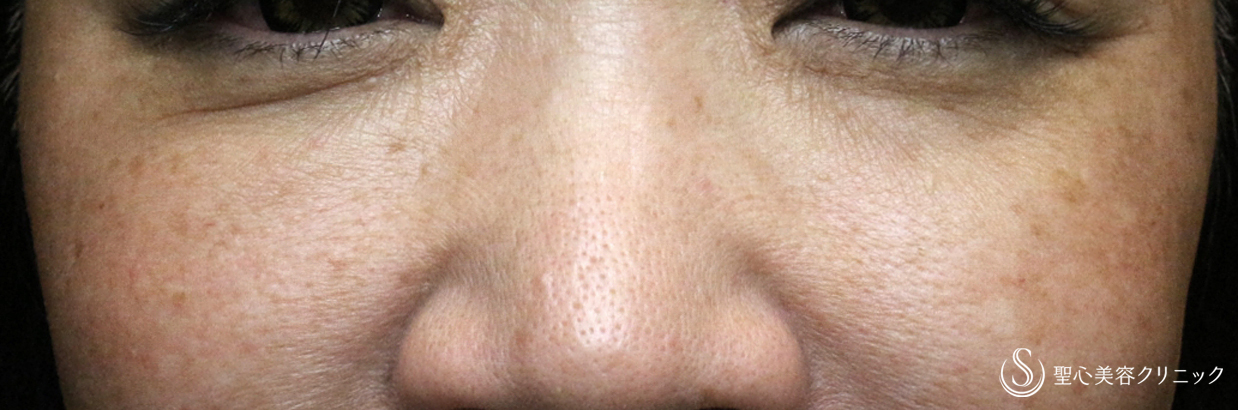 【50代女性・目の下のクマ】プレミアムPRP皮膚再生療法（2年後）札幌院 After 