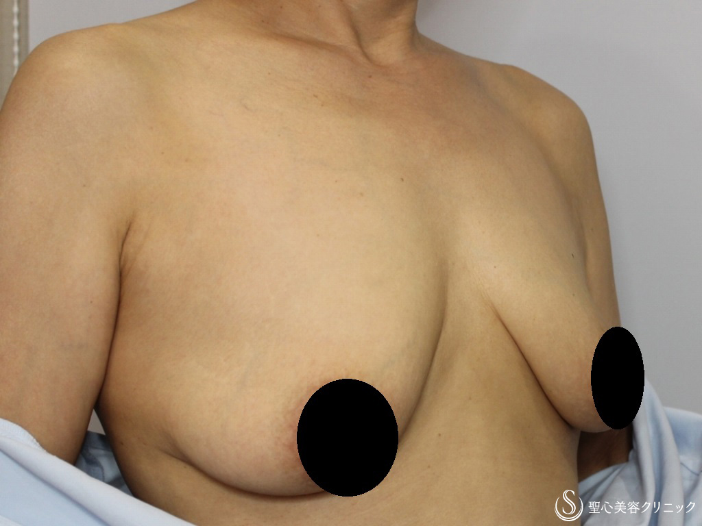 【50代女性・乳輪を小さく、下垂したバストを綺麗な形に】乳房つりあげ術＋乳輪縮小（3ヶ月後） Before 