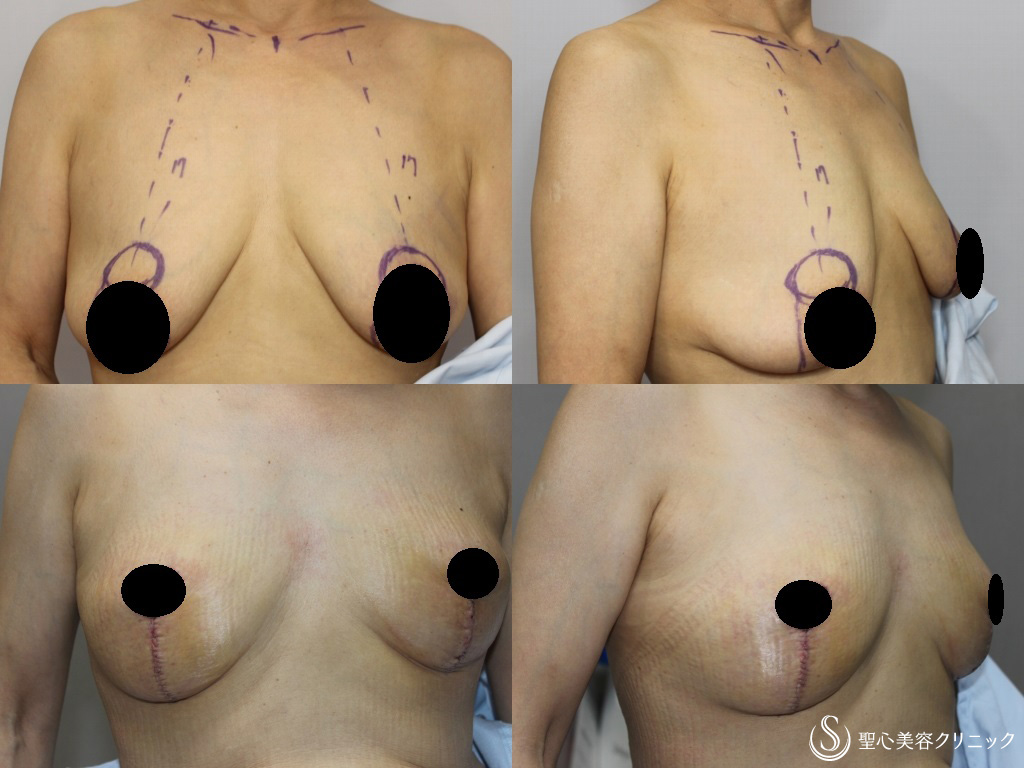 ぷっくり　乳輪 50代女性・乳輪を小さく、下垂したバストを綺麗な形に】乳房つりあげ術＋乳輪縮小（3ヶ月後） - 症例写真 - 美容整形、美容外科なら聖心美容クリニック