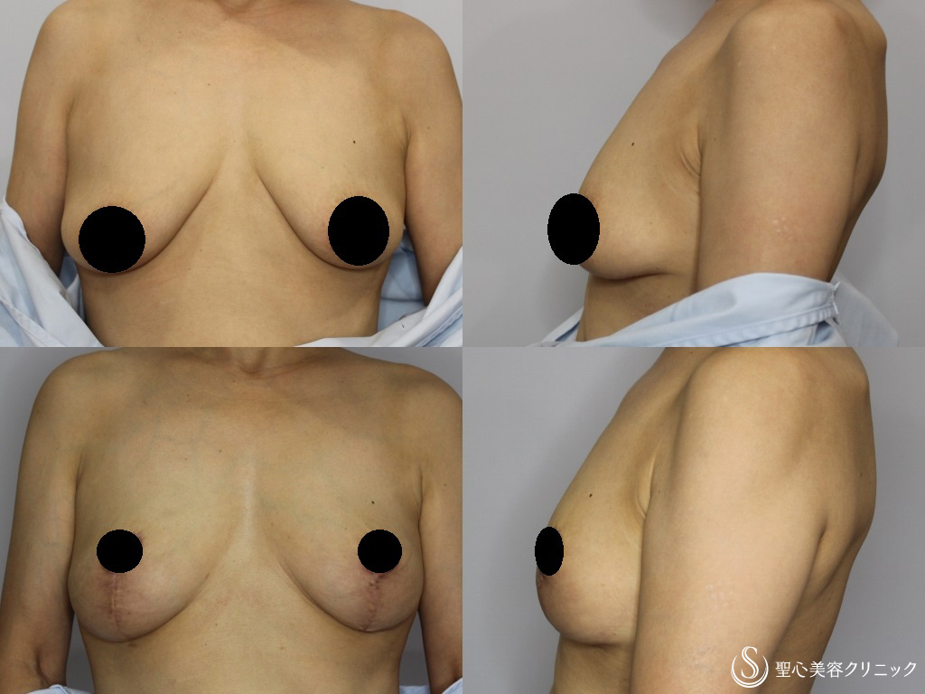 【50代女性・乳輪を小さく、下垂したバストを綺麗な形に】乳房つりあげ術＋乳輪縮小（3ヶ月後） After 