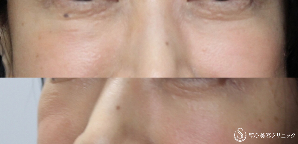 【40代女性・目の下の段差やクマが改善】プレミアムPRP 皮膚再生療法（7ヶ月後） After 