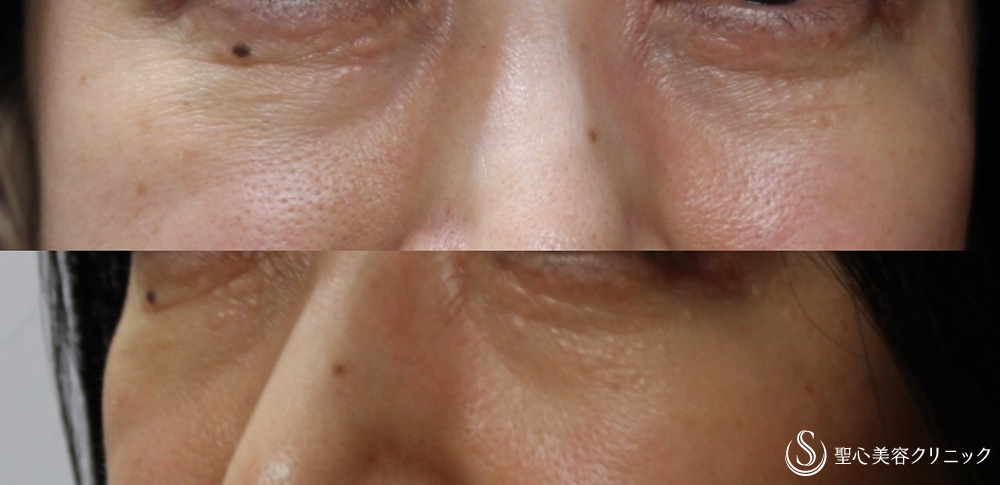 【40代女性・目の下の段差やクマが改善】プレミアムPRP 皮膚再生療法（7ヶ月後） Before 