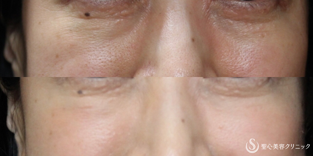 【40代女性・目の下の段差やクマが改善】プレミアムPRP 皮膚再生療法（7ヶ月後） After 
