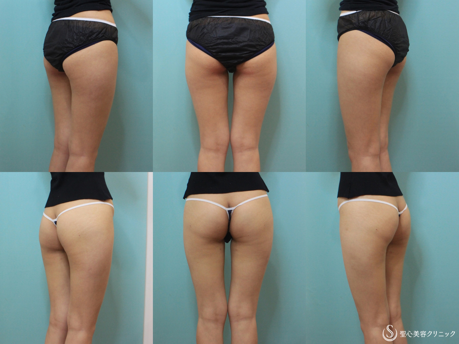 【20代女性・大腿外側の張り出しを改善】リポセル（大腿外側・後面・下臀部）（3ヶ月後） After 