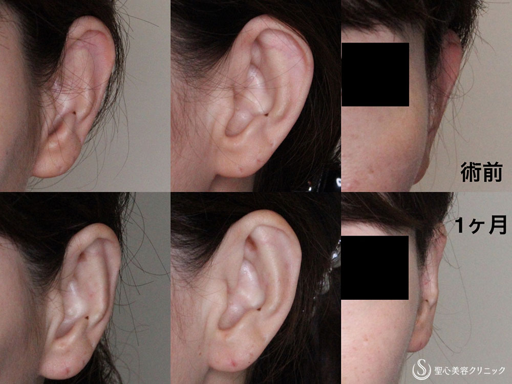 【40代女性・立ち耳（片側）】立ち耳修正埋没法（1ヶ月後） After 
