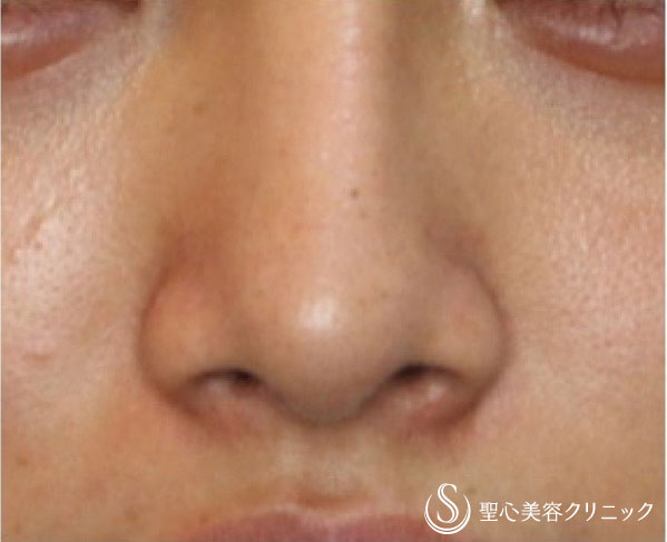 女性 よりほっそりしたお鼻へ 小鼻縮小 1週間後 症例写真 美容整形 美容外科なら聖心美容クリニック