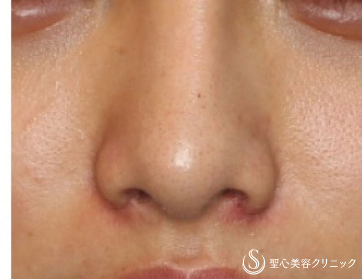 女性 よりほっそりしたお鼻へ 小鼻縮小 1週間後 症例写真 美容整形 美容外科なら聖心美容クリニック