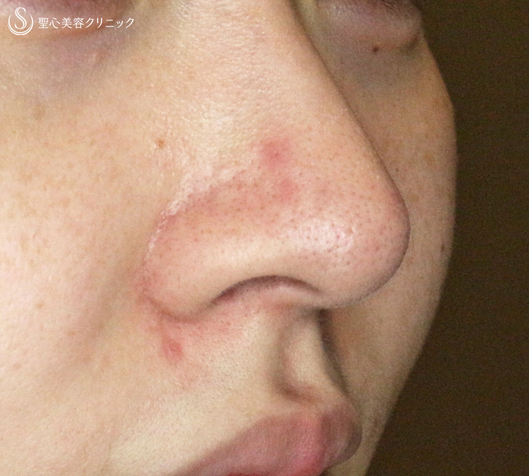【20代女性・小鼻がコンプレックスで...】小鼻縮小術+α法（1ヶ月後）札幌院 Before 