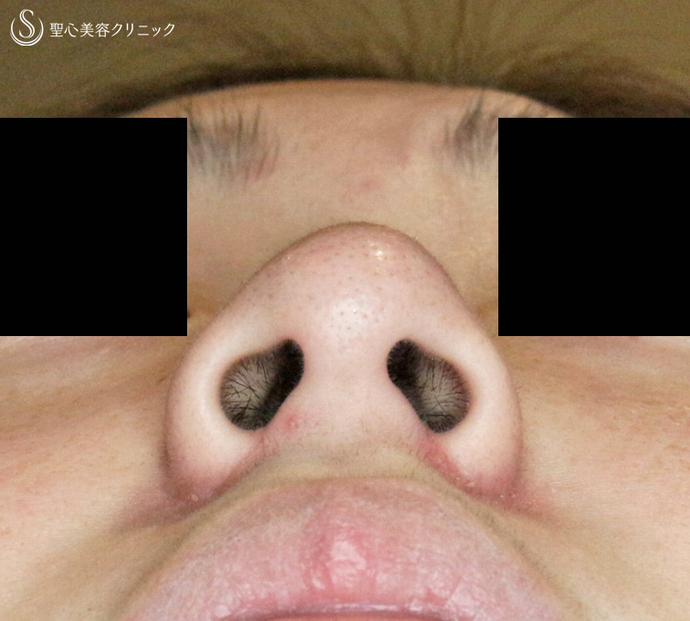 【20代女性・小鼻がコンプレックスで...】小鼻縮小術+α法（1ヶ月後）札幌院 After 