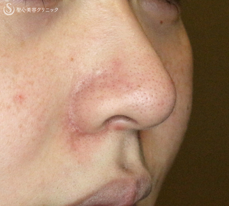 【20代女性・小鼻がコンプレックスで...】小鼻縮小術+α法（1ヶ月後）札幌院 After 