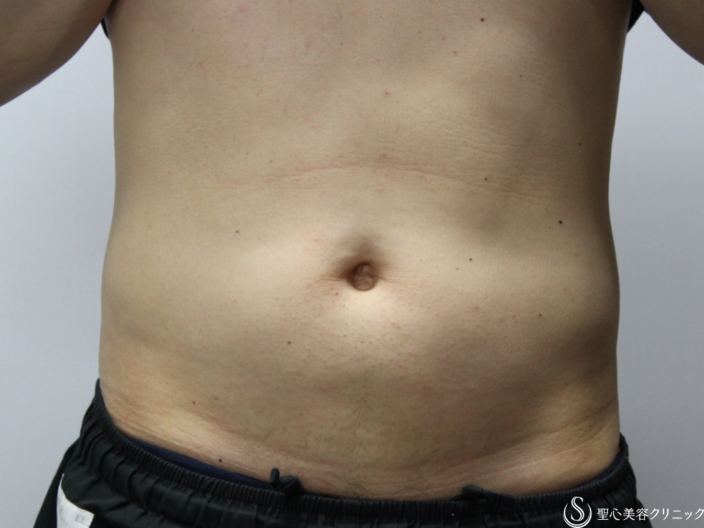 【40代男性・手軽に部分痩せ】腹部リポセルの新しい照射法(Grid法)（1ヶ月後） After 