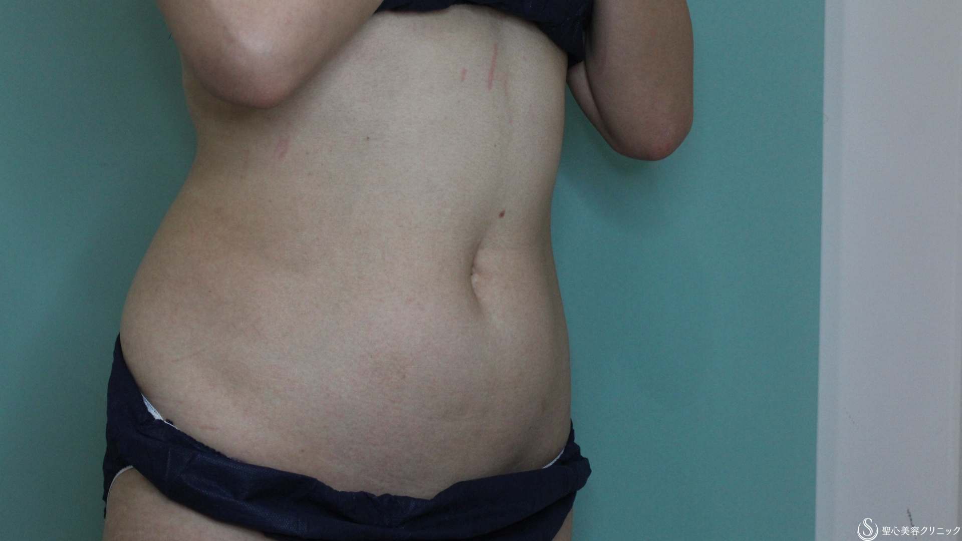 【40代女性・冷やすだけで部分痩せが叶う】冷却脂肪溶解療法クリスタル(腹部・ウエスト)（1ヶ月後） Before 