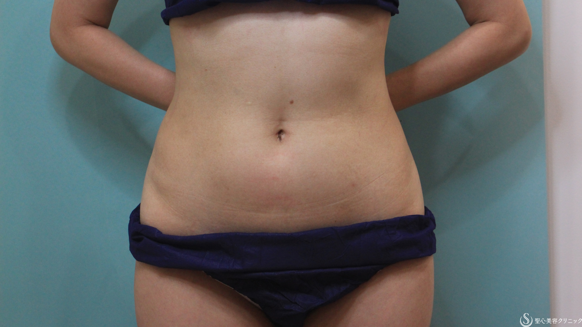 【40代女性・冷やすだけで部分痩せが叶う】冷却脂肪溶解療法クリスタル(腹部・ウエスト)（1ヶ月後） After 