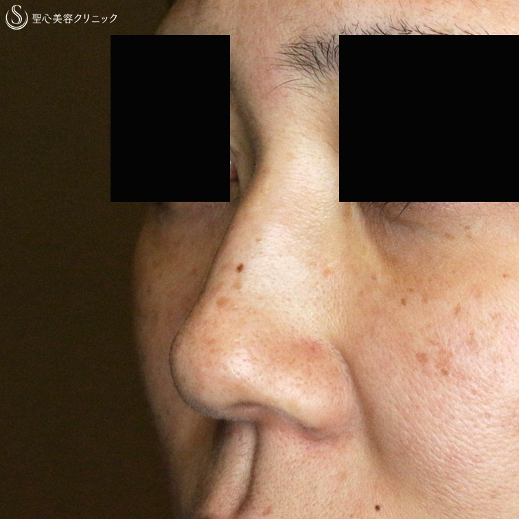 【40代女性・画期的な鼻のプチ整形】Gメッシュ単独（2年後） Before 