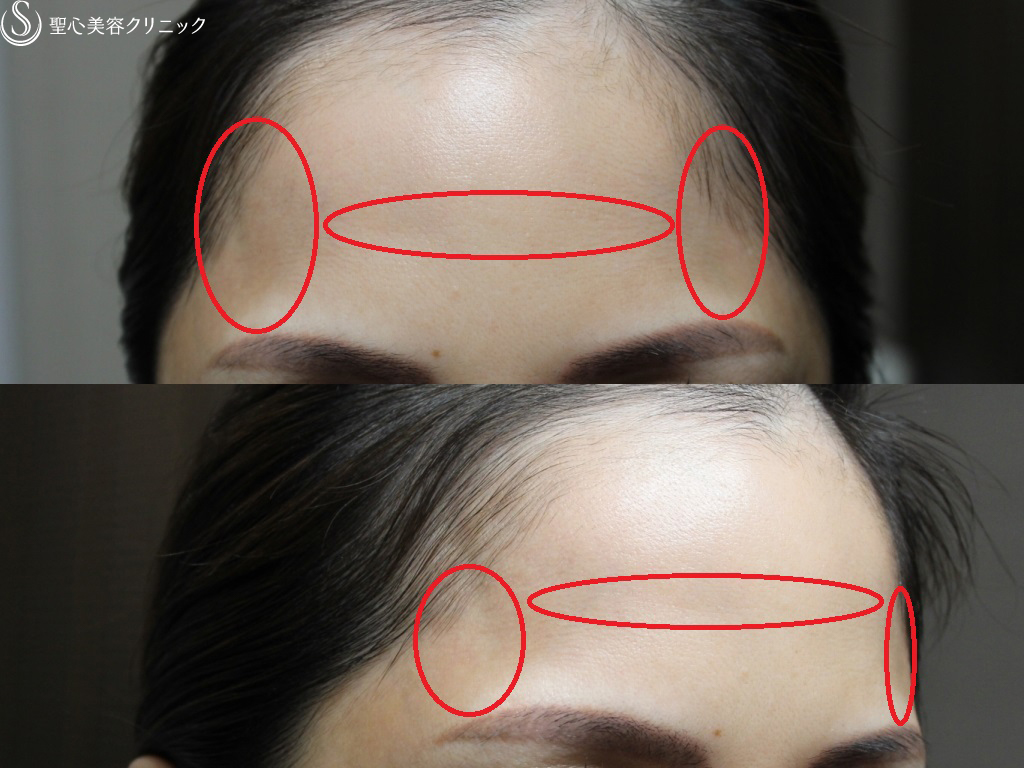 【40代女性・目立つ凹凸はなくなり綺麗な額に】額のプレミアムPRP（1ヶ月後） Before 