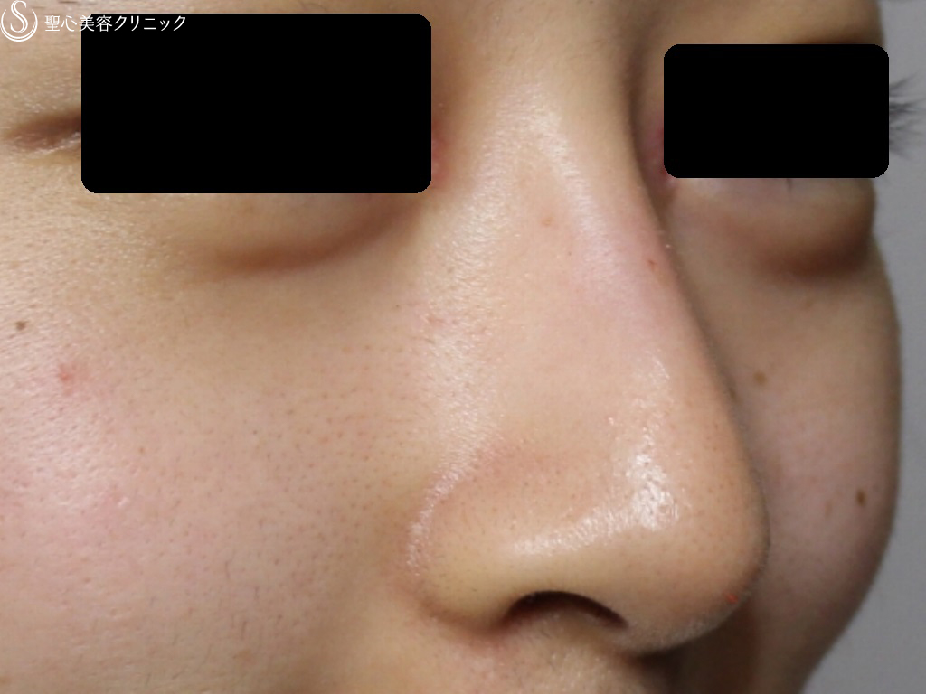 【40代女性・綺麗な鼻筋に】鼻のヒアルロン酸（クレヴィエル）（注入直後） After 