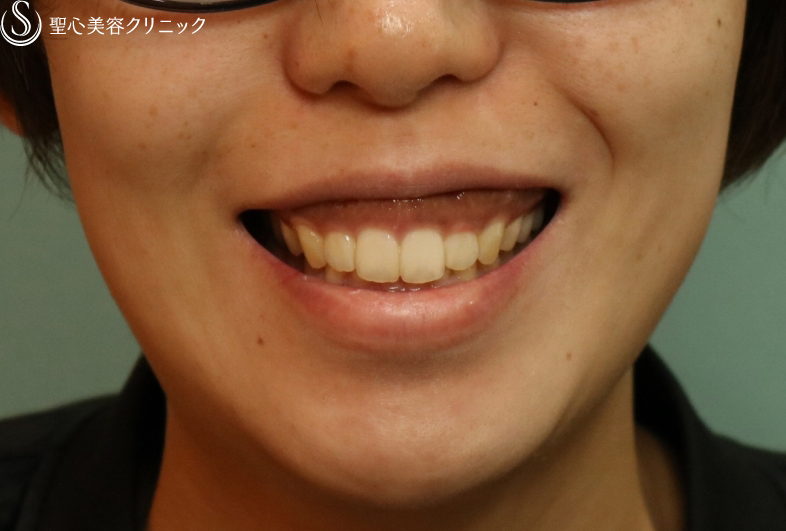 30代女性 笑顔に自信 切開でガミースマイル改善 1ヶ月後 症例写真 美容整形 美容外科なら聖心美容クリニック