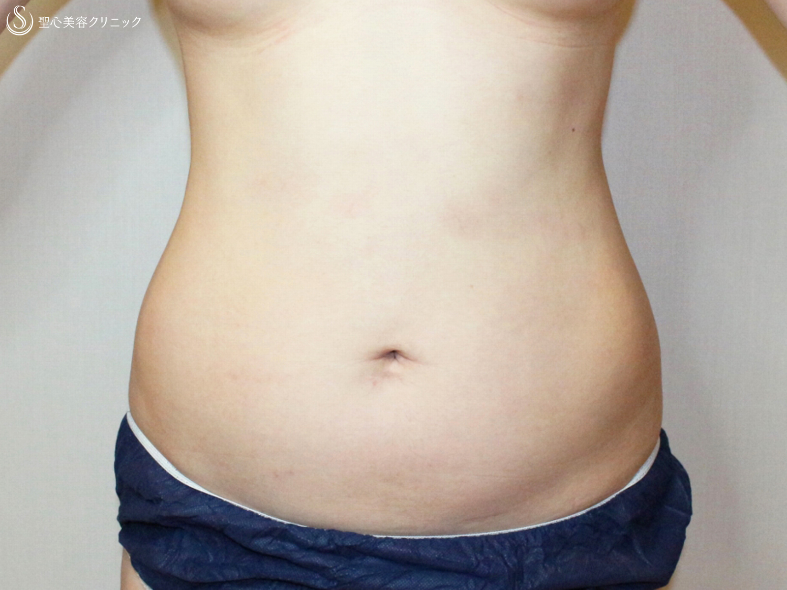 【30代女性・脂肪吸引は職人技】腹部全周ベイザー脂肪吸引（2ヶ月後） Before 