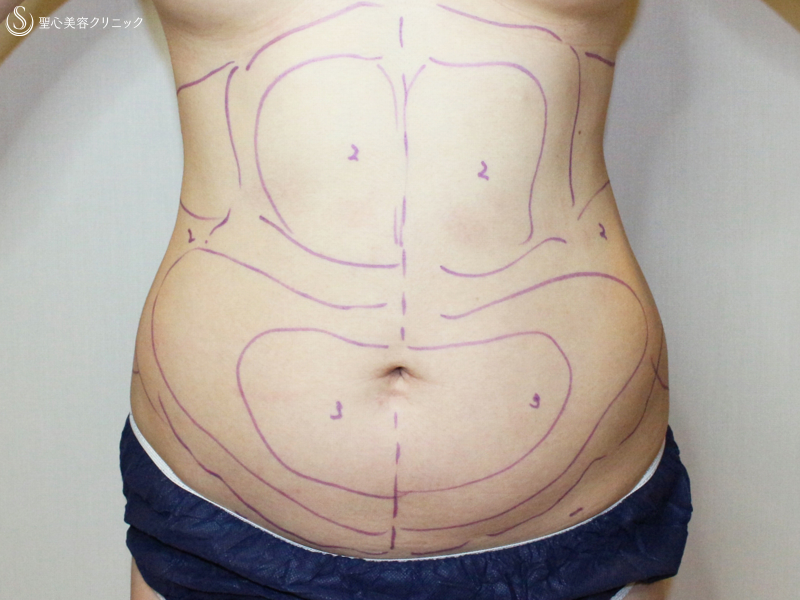 【30代女性・脂肪吸引は職人技】腹部全周ベイザー脂肪吸引（2ヶ月後） Before 