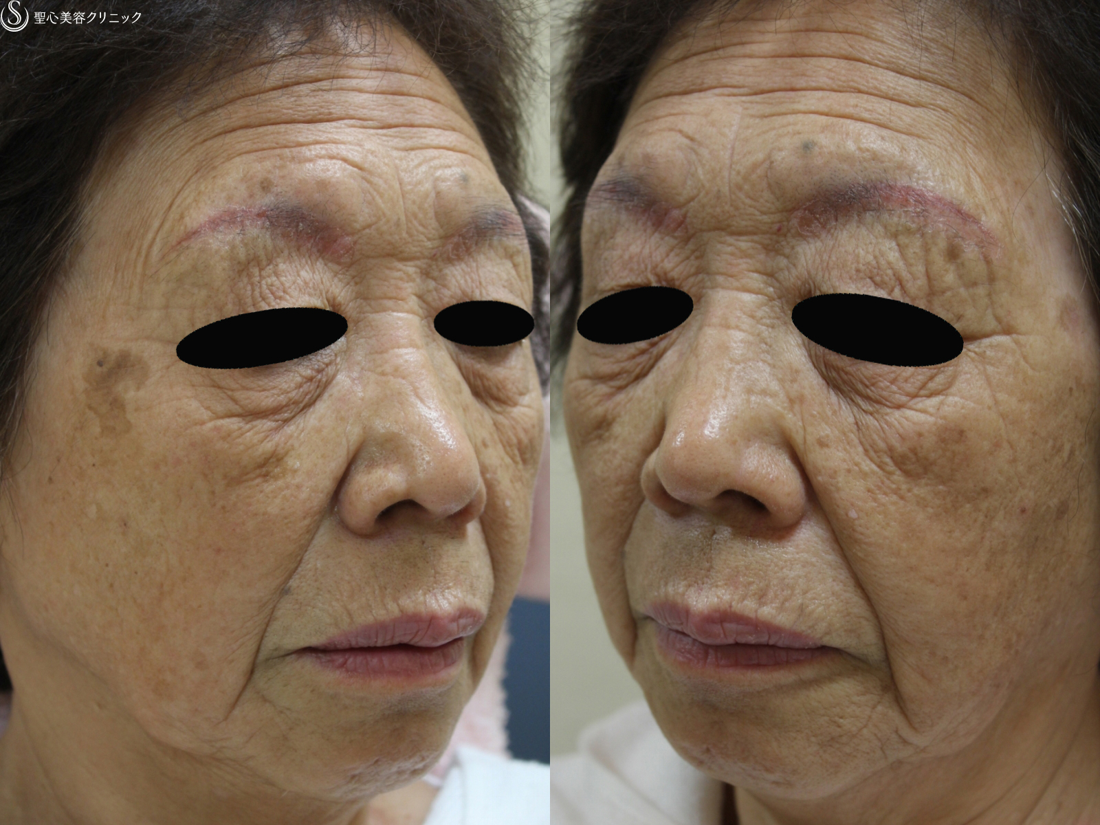 【80代女性・全顔の若返り】プレミアムPRP皮膚再生療法（4年5ヶ月後） Before 